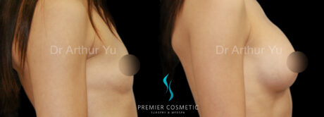 Breast Augmentation case #18357