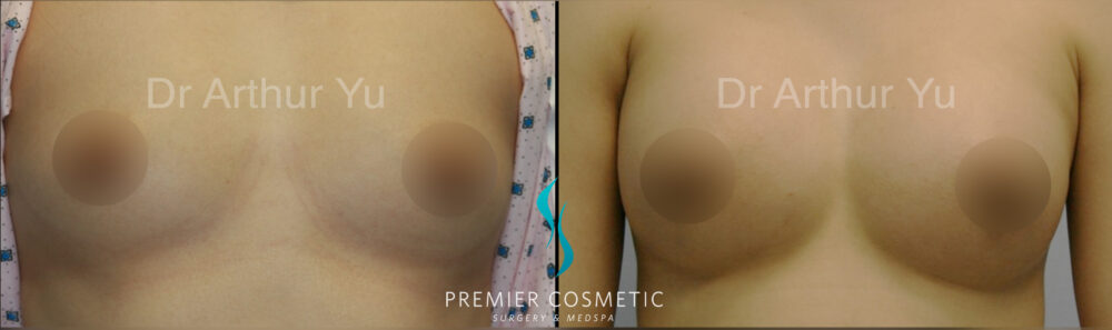 Breast Augmentation case #18319