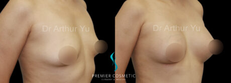 Breast Augmentation case #18355