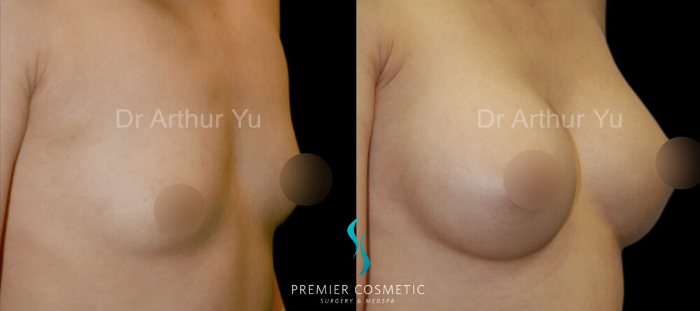 Breast Augmentation case #18351