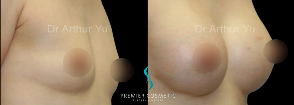 Breast Augmentation case #18349