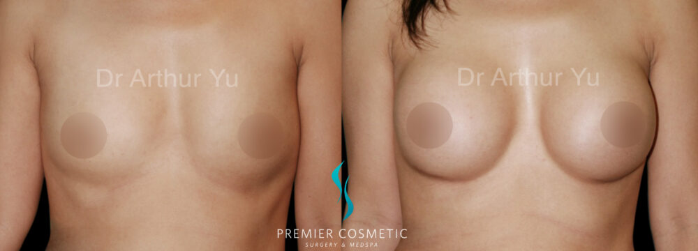 Breast Augmentation case #18347