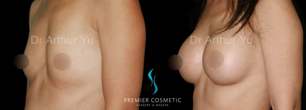 Breast Augmentation case #18345