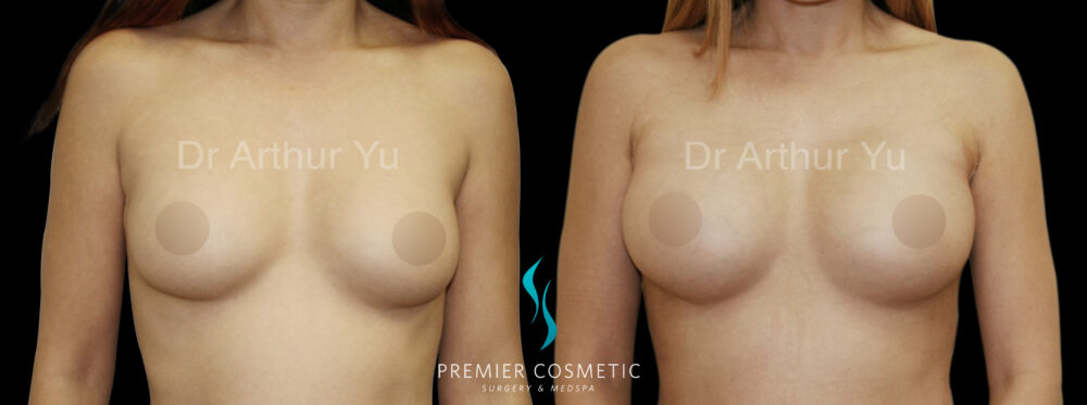 Breast Augmentation case #18343