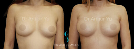 Breast Augmentation case #18343
