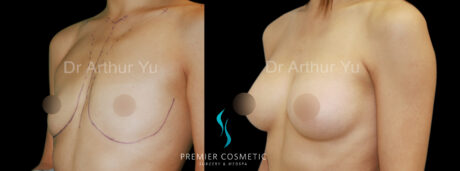 Breast Augmentation case #18341