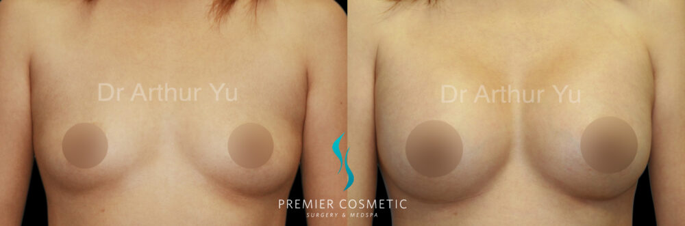 Breast Augmentation case #18339