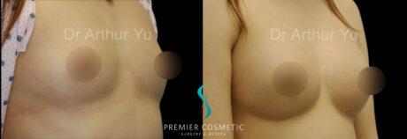 Breast Augmentation case #18373