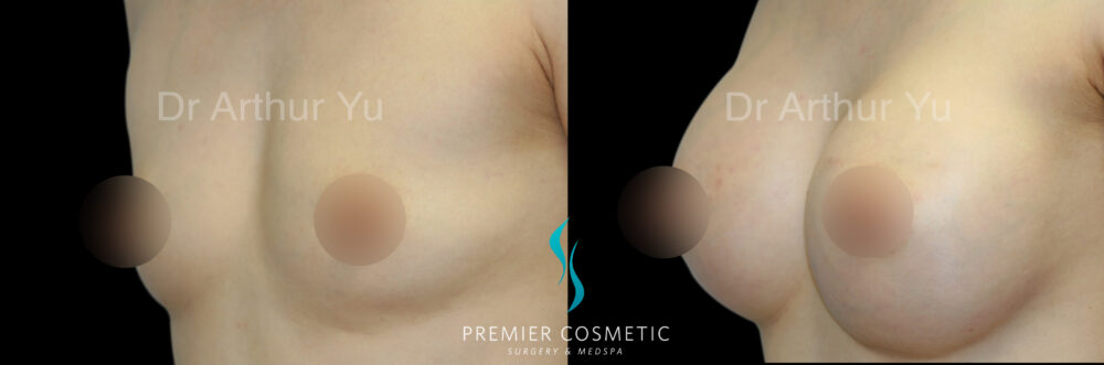 Breast Augmentation case #18337