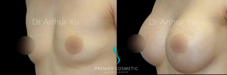 Breast Augmentation case #18337