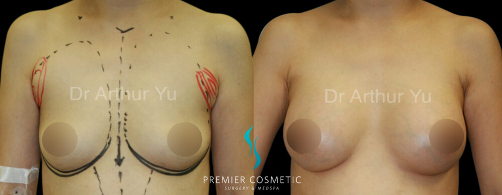 Breast Augmentation case #18335