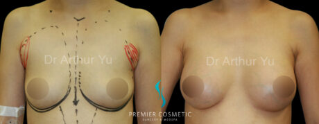 Breast Augmentation case #18335