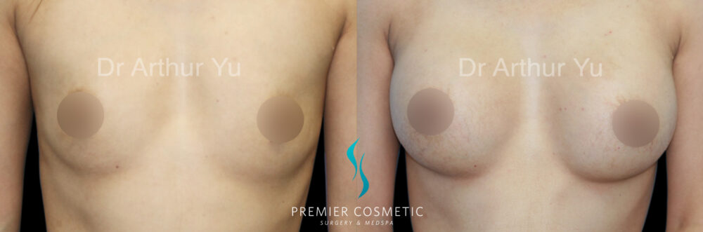 Breast Augmentation case #18333