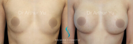 Breast Augmentation case #18333