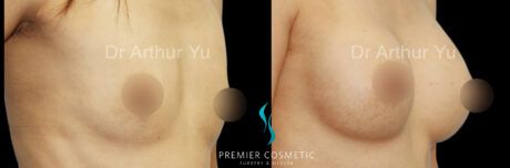 Breast Augmentation case #18331