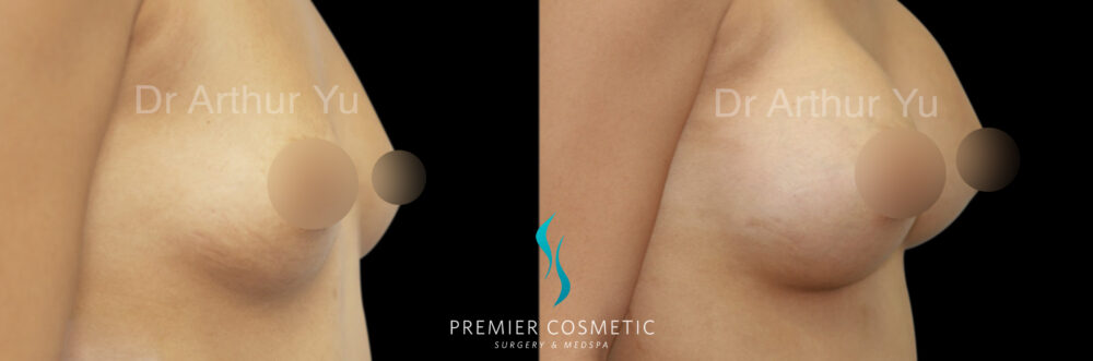 Breast Augmentation case #18329