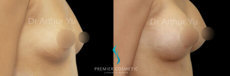 Breast Augmentation case #18329