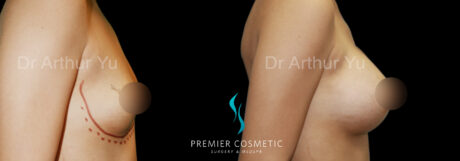 Breast Augmentation case #18327