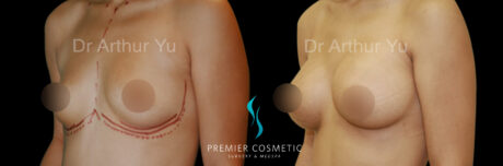 Breast Augmentation case #18325