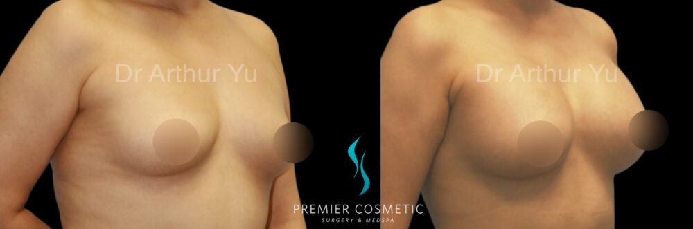 Breast Augmentation case #18323