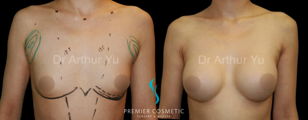 Breast Augmentation case #18321