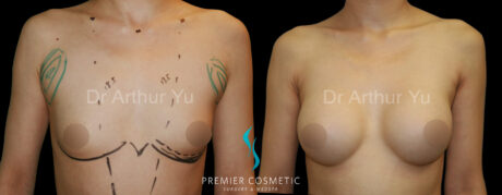 Breast Augmentation case #18321