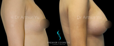 Breast Augmentation case #18371