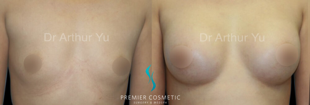 Breast Augmentation case #18369