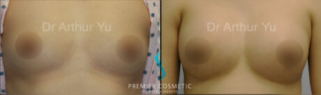 Breast Augmentation case #18319