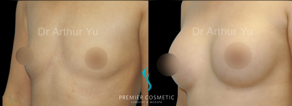 Breast Augmentation case #18367