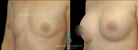 Breast Augmentation case #18367