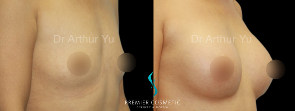 Breast Augmentation case #18365