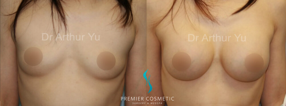 Breast Augmentation case #18363