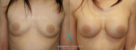 Breast Augmentation case #18363