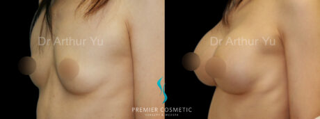 Breast Augmentation case #18361