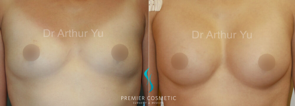 Breast Augmentation case #18359