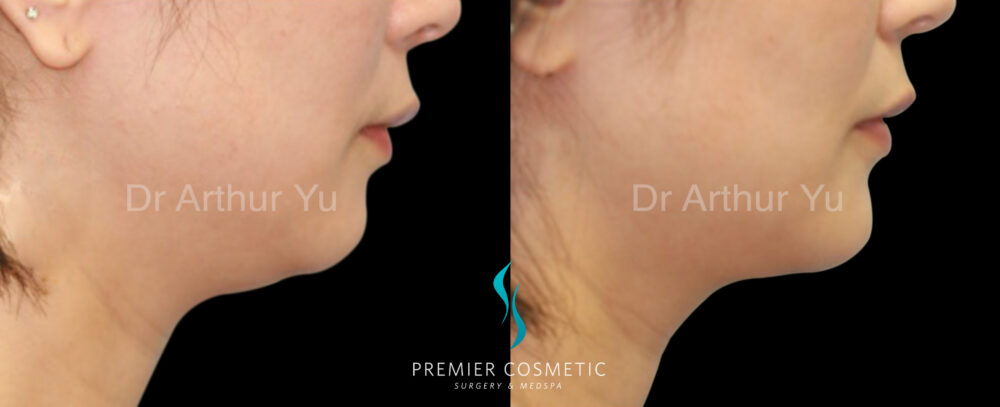 Chin Augmentation case #18303
