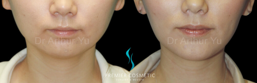 Chin Augmentation case #18305