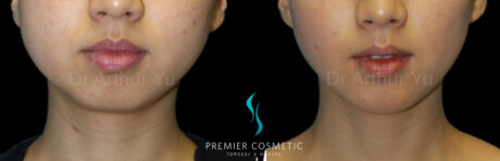 Chin Augmentation case #18307