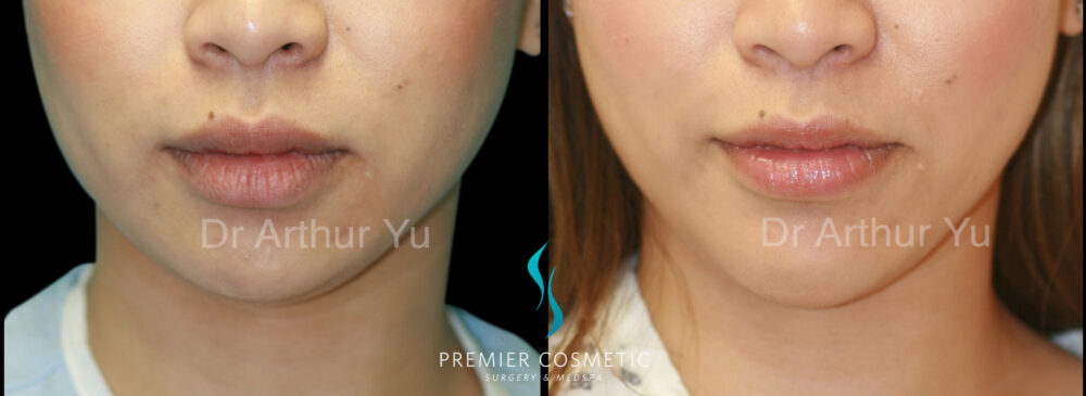 Chin Augmentation case #18311