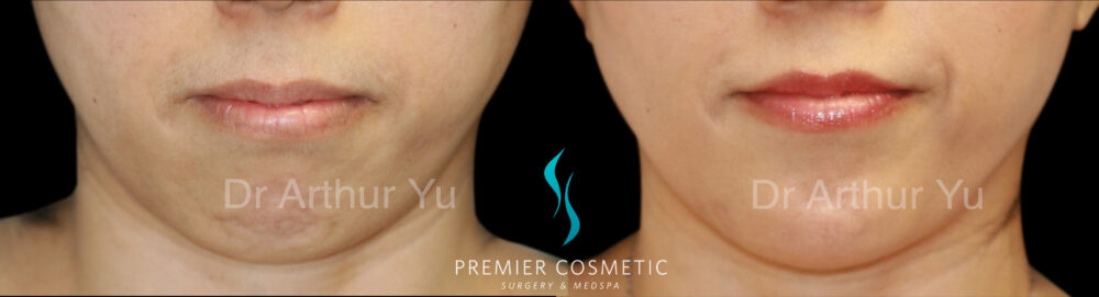 Chin Augmentation case #18309