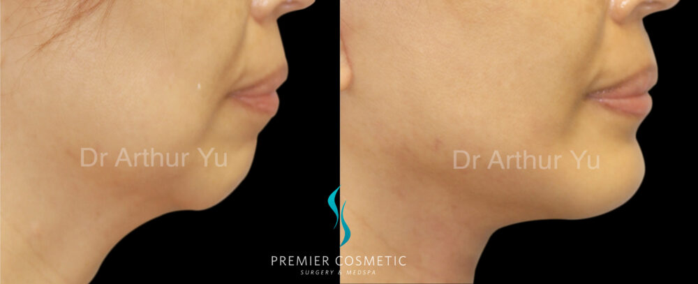 Chin Augmentation case #18293