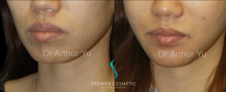 Chin Augmentation case #18297