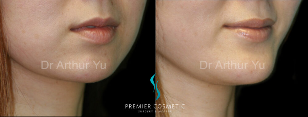 Chin Augmentation case #18295