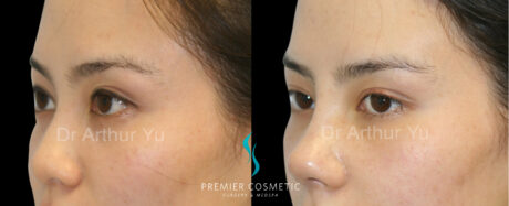 Rhinoplasty case #18285