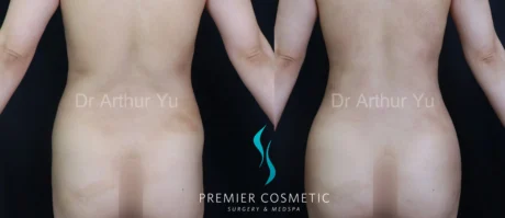 Hourglass Sculpting case #19089
