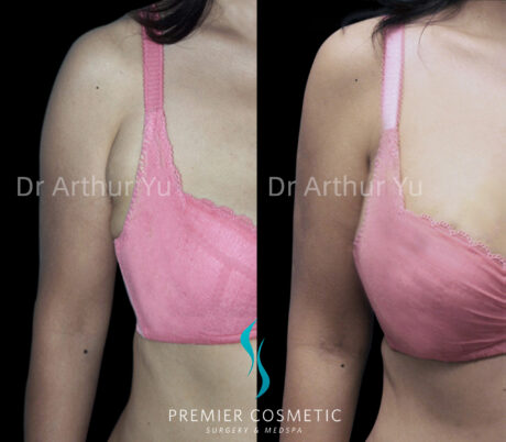 Accessory Breast Removal case #19111