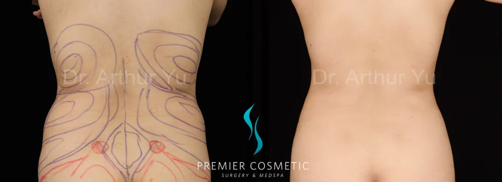 Hourglass Sculpting case #19091