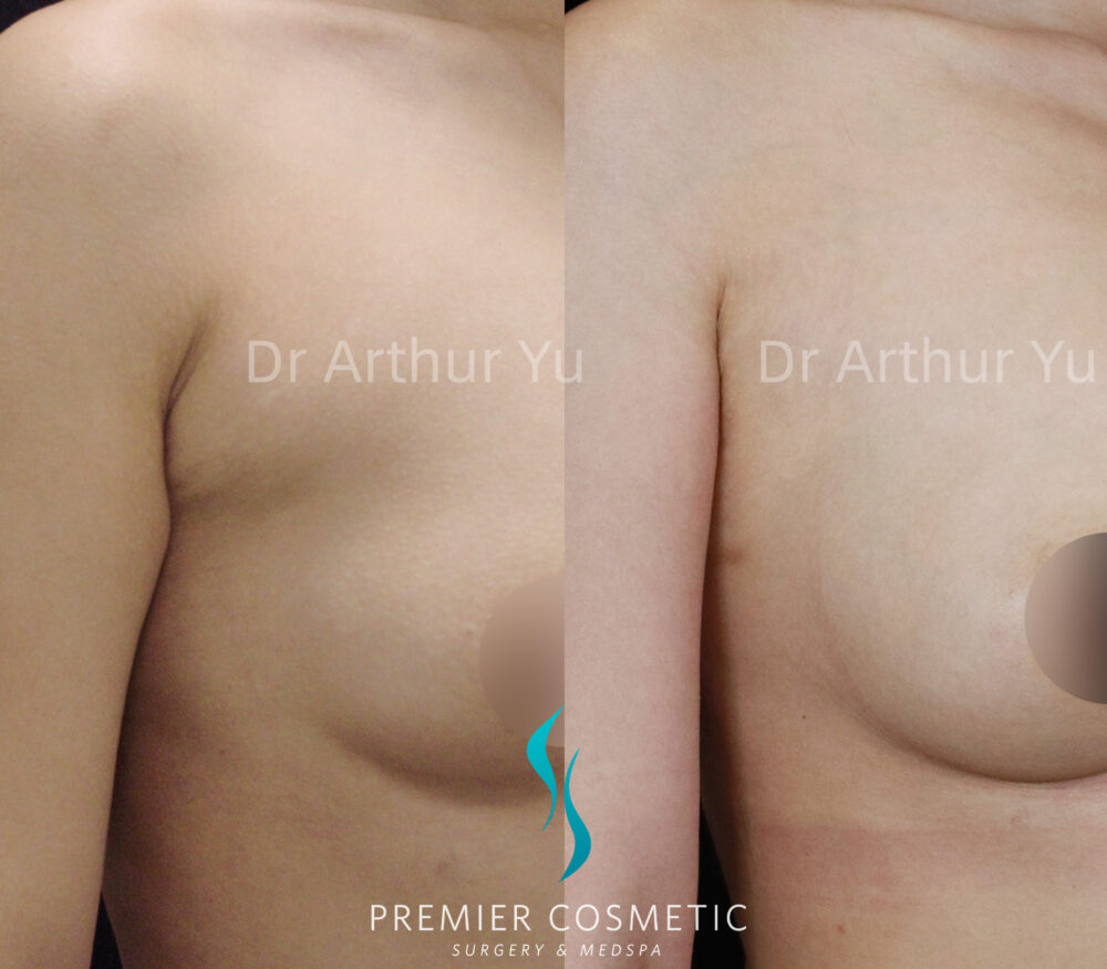 Accessory Breast Removal case #19123