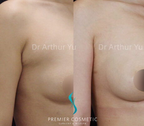 Accessory Breast Removal case #19123
